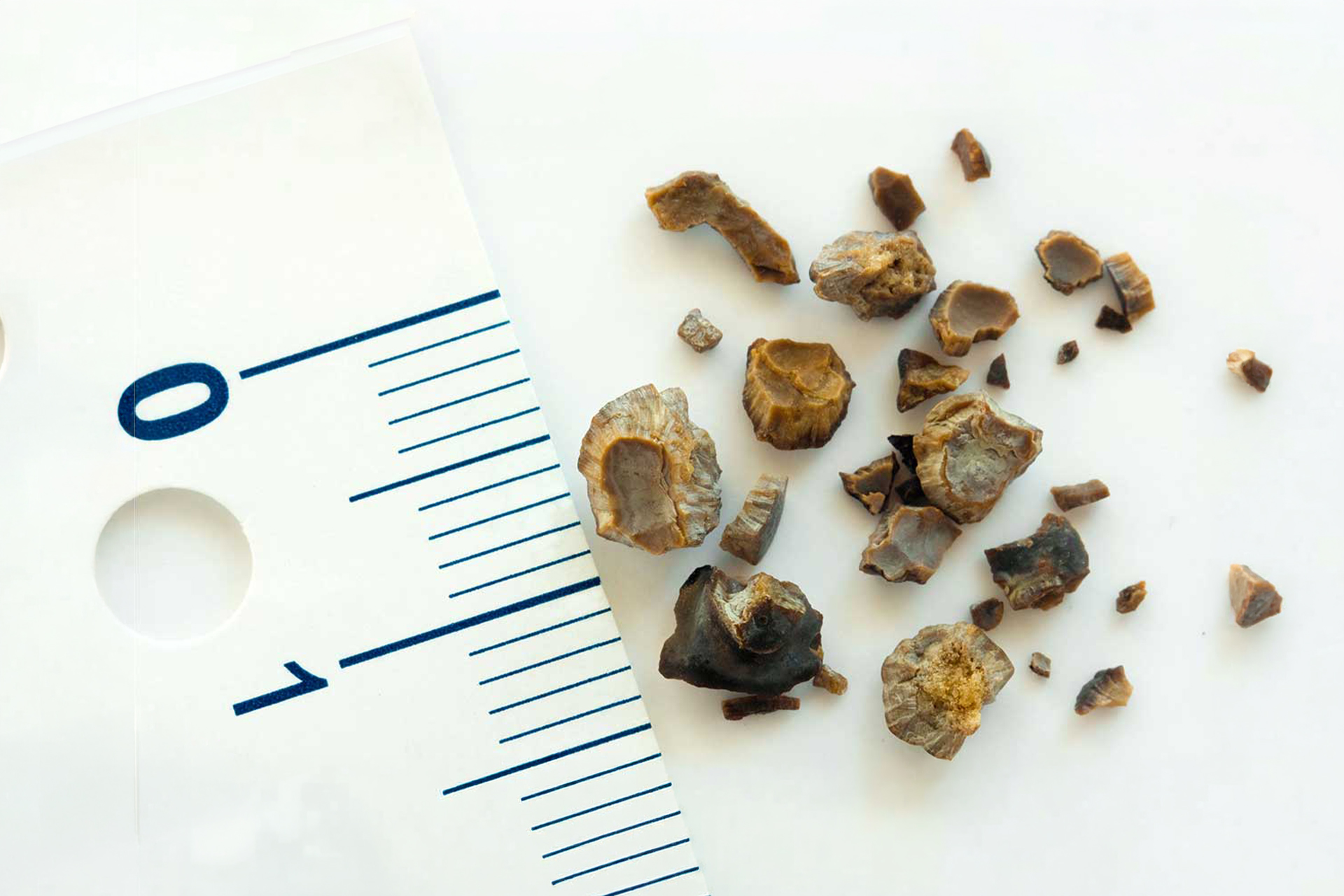 Kenali Perbedaan Gejala Batu Ginjal dan Kencing Batu